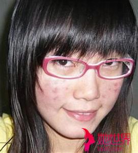 耳蜗里长痘痘一碰就疼 长痘不用怕 长哪就按哪