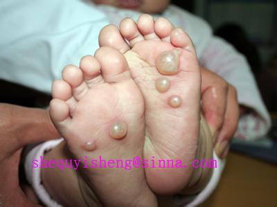 宝宝得手足口病好治吗 宝宝手足口病多久能好