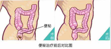 化疗后便秘如何通便 立刻见效的通便方法，让你不再为便秘发愁！