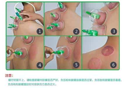 真空丰胸拔罐器有用吗 真空拔罐手法