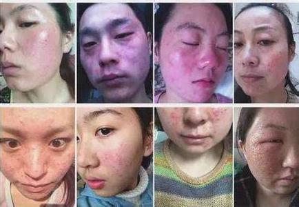 脸部激素性皮炎 严重激素性皮炎怎么办 不同严重程度激素脸该如何对症处理?