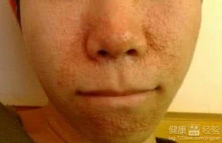 肾炎浮肿的程度 肾炎浮肿的验方