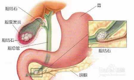 胆结石的征兆 胆结石有什么征兆?