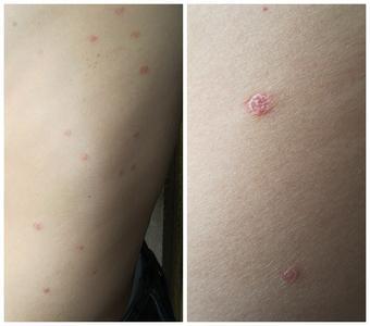 阴唇上长绿豆大的疙瘩 图文：身上疙瘩红肿，小小绿豆显功