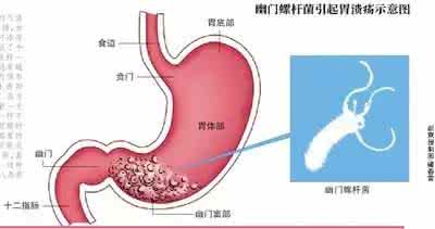 幽门螺杆菌感染与胃癌 干掉幽门螺杆菌，胃癌风险降四成，专家教你怎么干掉它！