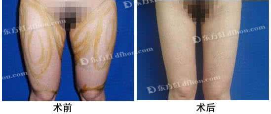 吸脂减肥手术会反弹吗 吸脂手术 吸脂减肥手术