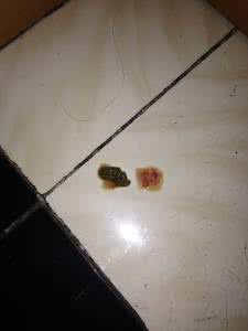 拉肚子出血是什么原因 拉肚子出血是什么原因 拉肚子带血怎么回事 拉肚子带血什么原因