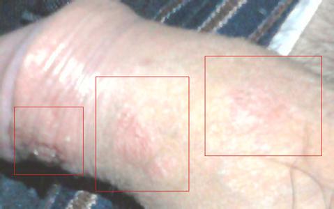 阴囊瘙痒的原因 阴囊瘙痒 阴囊瘙痒的原因