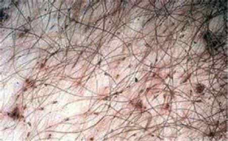 阴虱症状有哪些 阴虱症状 阴虱有哪些症状