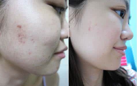 skii去痘印 99%的人都不知道...去痘去斑的免費SKII原來在你家！後悔看晚了阿！（转）