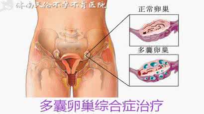 多囊卵巢综合症的症状 卵巢多囊综合症症状有哪些