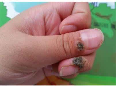 寻常疣怎么治疗最好 寻常疣最佳治疗方法 怎么治疗寻常疣