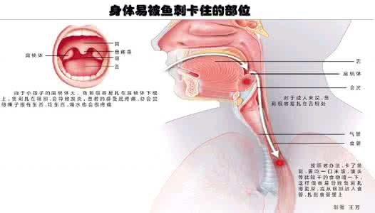喉咙有鱼刺卡住小巧门 喉咙有鱼刺卡住小巧门 【鱼刺卡到喉咙怎么办】被鱼刺卡住喉咙怎么办