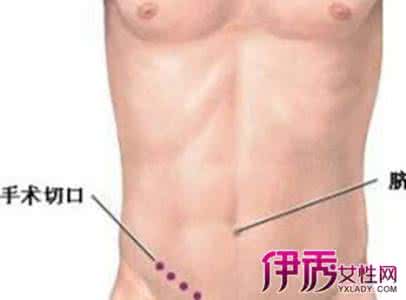 阑尾炎手术后吃什么好 阑尾炎吃什么好 阑尾炎怎么吃