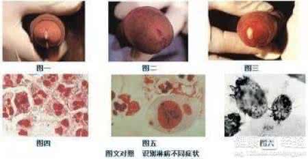 淋病多久能治愈 淋病能治好吗 淋病能治愈吗