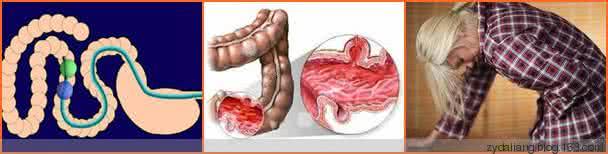 结肠炎的治疗偏方大全 偏方大全连载——治疗结肠炎*