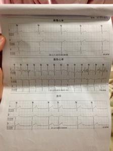 小儿窦性心动过缓 小儿窦性心动过缓 小儿窦性心动过缓的检查