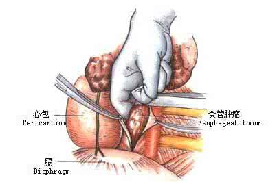 贲门癌晚期怎么治疗 贲门癌晚期   贲门癌晚期怎么治疗