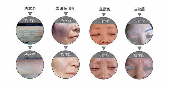 太田痣的形成原因 太田痣的形成原因 形成痣的原因？