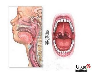扁桃体发炎治疗方法 扁桃体发炎怎么办 治疗扁桃体的有效方法