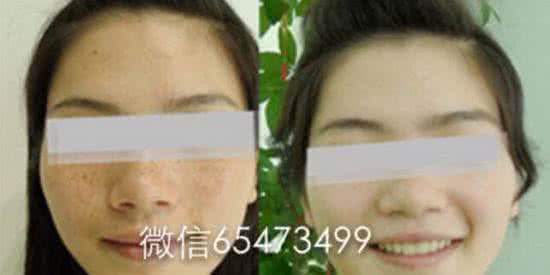 祛斑的偏方 中医祛斑的16中偏方