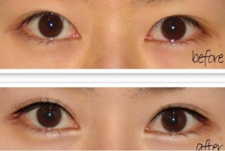 割双眼皮哪家医院好 割双眼皮哪个医院好 割双眼皮医院哪家好