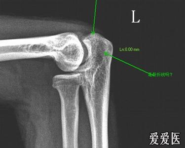 尺骨鹰嘴骨折的后遗症 尺骨鹰嘴骨折 尺骨鹰嘴骨折的检查