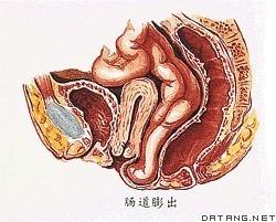 胎儿肠膨出 肠膨出