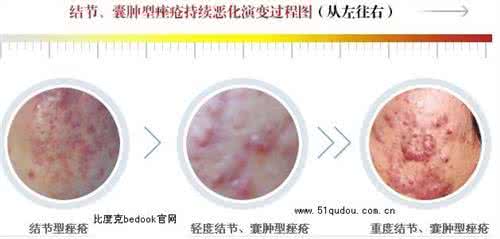 痤疮的症状 痤疮的危害 痤疮的症状 痤疮的危害