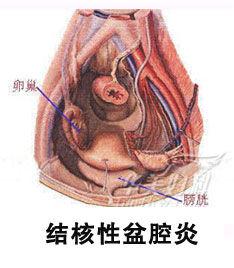 急性盆腔炎中医护理 急性盆腔炎的中医辨治