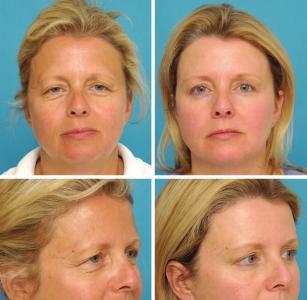 深圳做提眉整形术费用 内镜下眉部和前额整形术