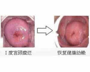 子宫糜烂需要怎样治疗 子宫糜烂需要怎样治疗 该怎样让“他”get到我的需要