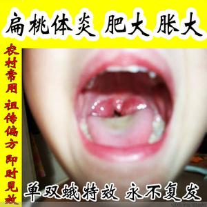 治疗扁桃体炎的偏方 扁桃体炎偏方 偏方消灭“扁桃体炎”