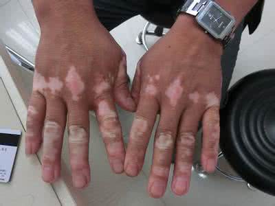 甲亢发病的原因是什么 白癜风的发病原因是什么 最直接的是什么