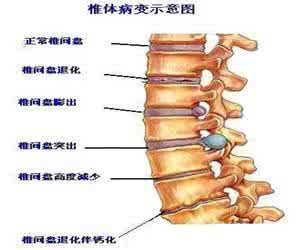 腰椎间盘突出功能锻炼 腰椎间盘突出治疗 10字经恢复腰部功能