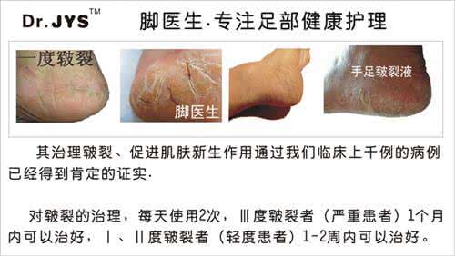 脚后跟脱皮怎么治疗 治療腳後跟乾燥脫皮