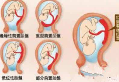 胎盘后壁生男生女 胎盘后壁生男生女 胎盘后壁生男生女呢
