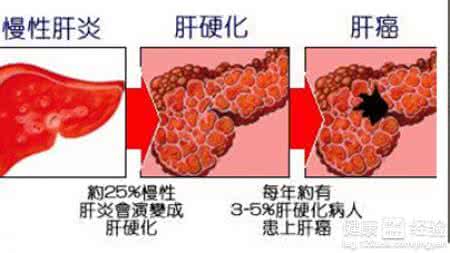 肝硬化早期可以治愈吗 肝硬化早期可以治愈吗 什么是早期肝硬化 肝硬化早期能治好吗