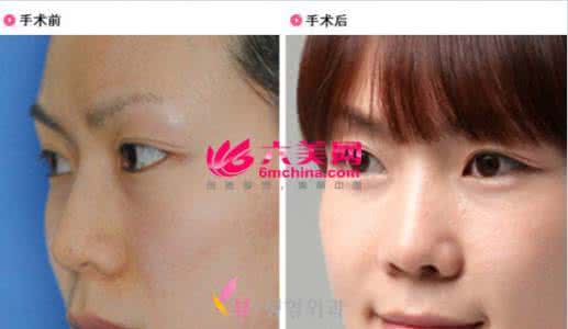 拯救塌鼻子 做塌鼻子整形 鼻子整形 拯救你的塌塌鼻