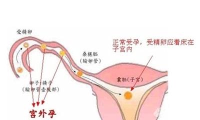 宫外孕早期症状 孕早期宫外孕症状 孕期知识 宫外孕早期症状