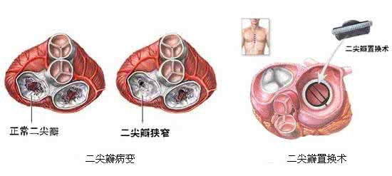 风湿性心脏病能治愈吗 风湿性心脏病症状