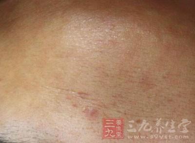 手肘长疙瘩越抓越痒 身上痒一抓就起疙瘩 身上痒一抓就起疙瘩 身体长疙瘩什么原因