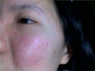皮肤过敏治疗方法 皮肤过敏治疗偏方 皮肤过敏治疗方法 过敏的小偏方