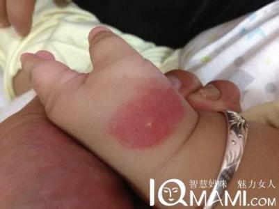 被蚊子叮咬后起大包 被蚊子叮咬后为什么会有包