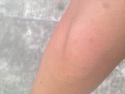 艾滋病皮疹特点和图片 艾滋病皮疹 分辨艾滋病皮疹和普通皮疹