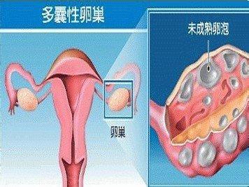 多囊卵巢怀孕几率大吗 多囊卵巢能怀孕吗