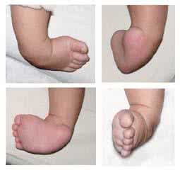 马蹄内翻足矫正鞋 马蹄内翻足