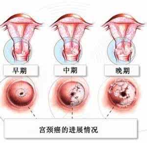 宫颈充血是怎么回事 宫颈充血是怎么回事 宫颈充血的致病因素有哪些