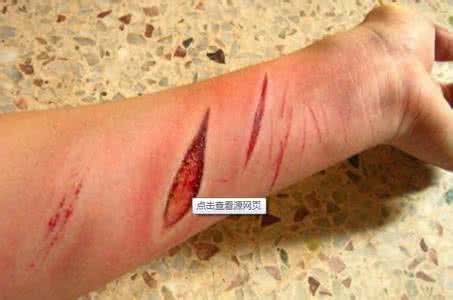 吃什么能利于伤口愈合 吃什么伤口愈合得快