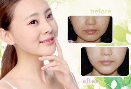 肉毒素瘦脸针 肉毒素瘦脸针 肉毒瘦脸针要多久才能生效呢